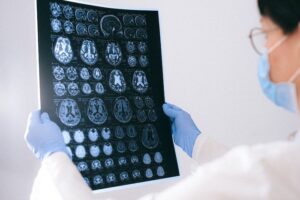 Female doctor holding brain scans in Nottingham